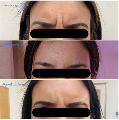 botox morristown tn|More.